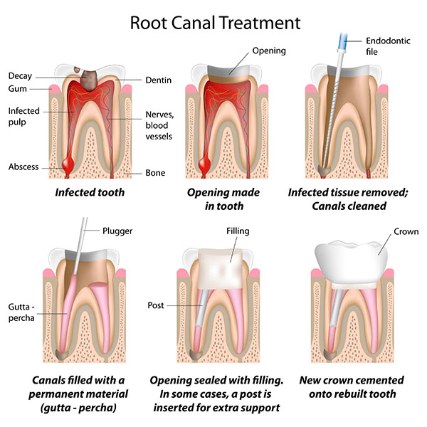 Root Canal Dentist in Anaheim